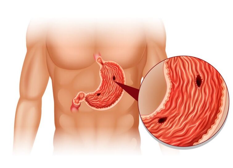 ulcer as a cause of pain under the left back scapula