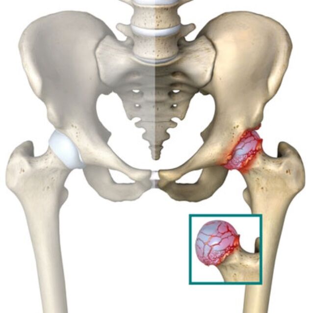 hip joint arthrosis