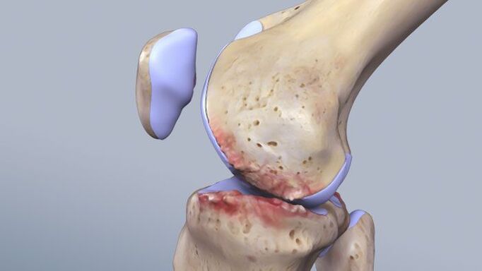 The structure of the knee joint is affected by pathology