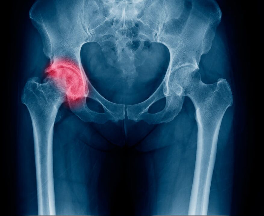 A fracture of the femoral neck causes pain that radiates to the leg