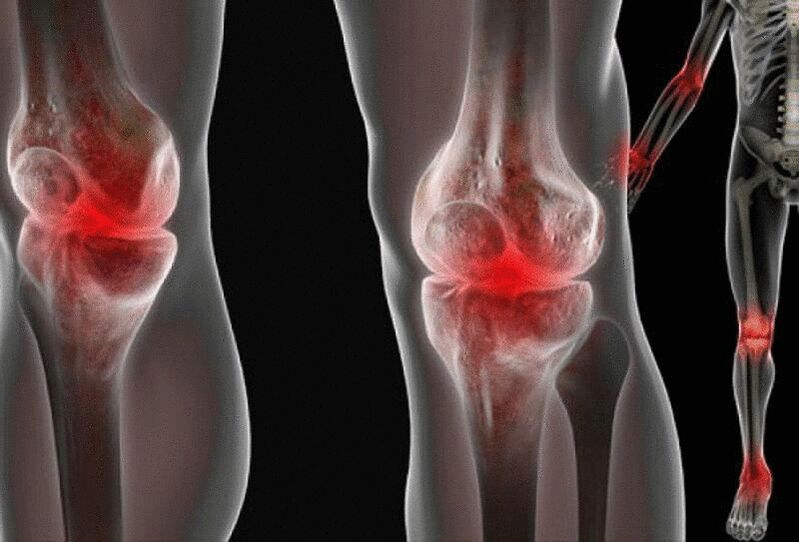 Pain in the joints of the arms and legs is caused by various diseases