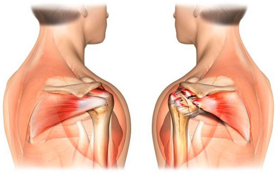 A healthy shoulder affected by arthrosis