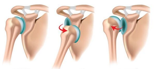 Dislocation of the anterior and posterior shoulder joints, triggering the development of arthrosis