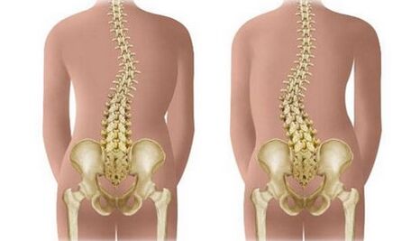 Scoliosis that can't stand