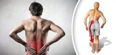 Pain syndrome with lumbar osteochondrosis radiating to the feet