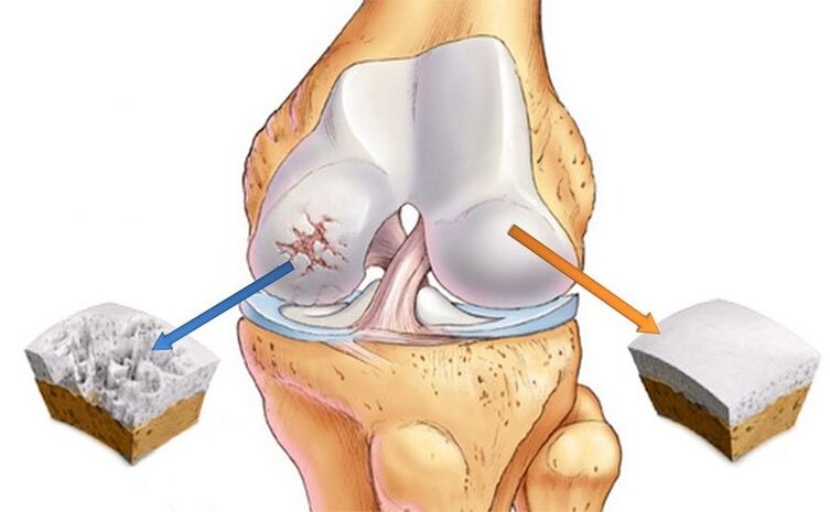 Cartilage is normal and influenced by arthrosis