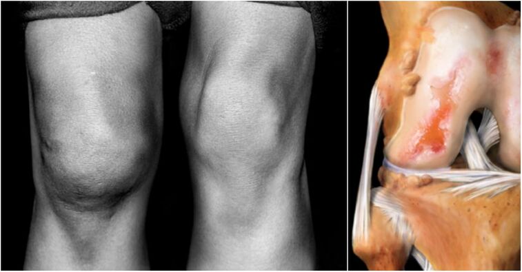 Knee joint arthrosis and pain joint