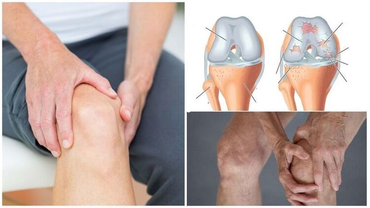 Symptoms of knee pain arthrosis knee joint