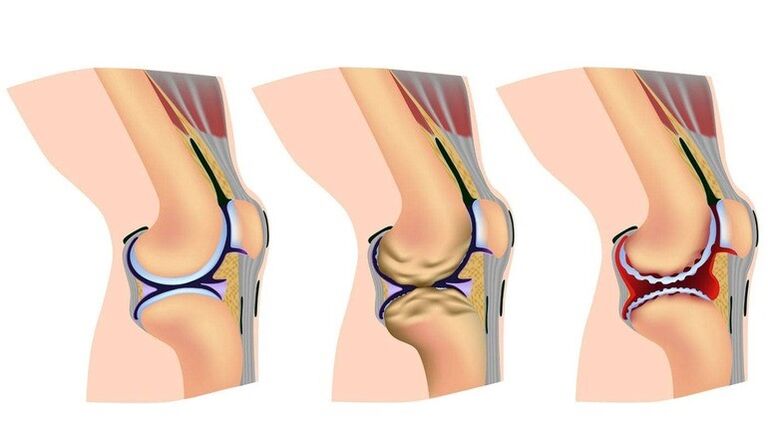 The stages of deformation in the knee joint for arthrosis