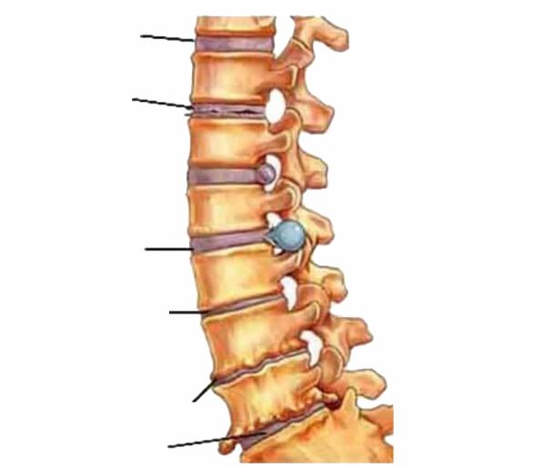 Damage to the spine causes back pain