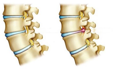 healthy discs and disc herniations