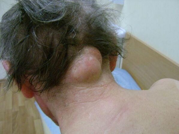 swelling in the neck as a cause of pain